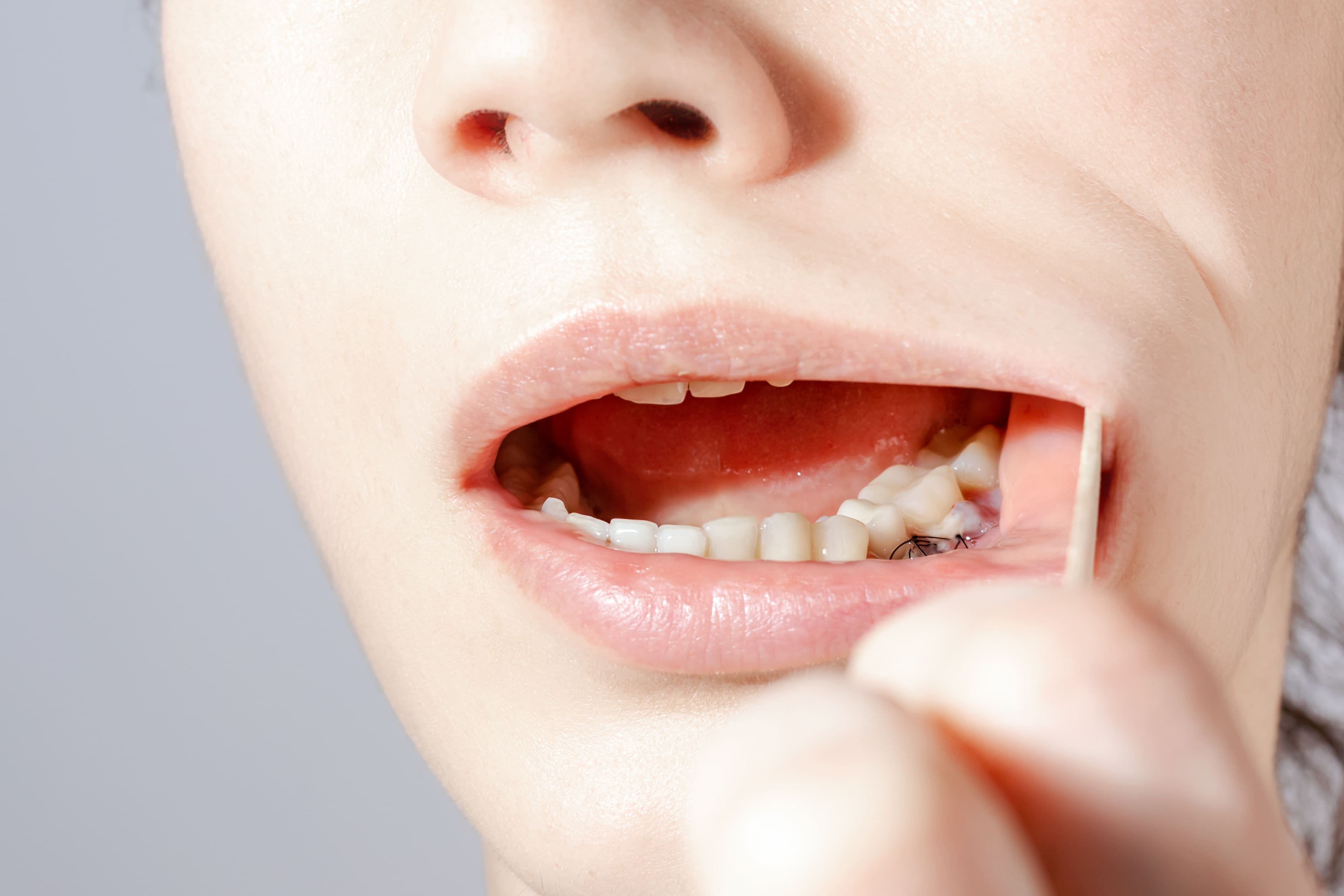 What Is Gum Tissue Conditioning? Mercer Island Dental